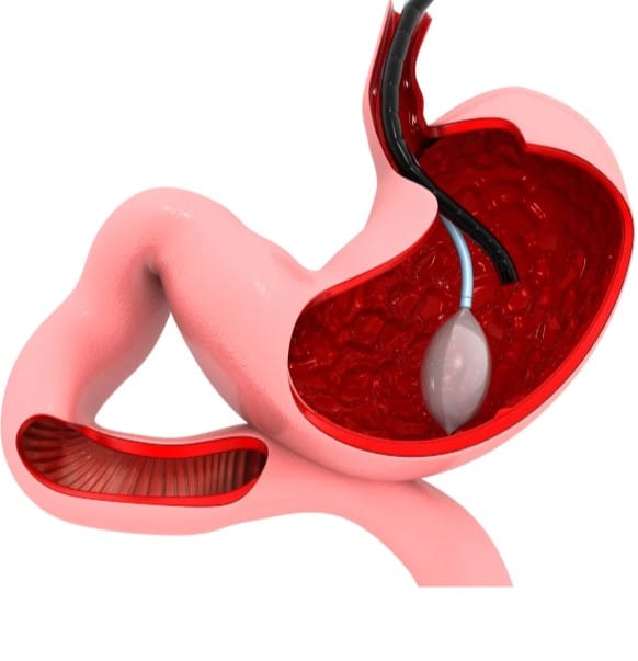 Balón gástrico en Bogotá-Dra.-Paola-Sanchez- Método 4 PRO - Perdida-de-peso-en-Bogota